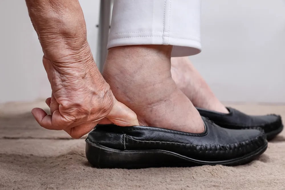 Dấu hiệu nhận biết sưng tấy và nhức mỏi chân người lớn tuổi