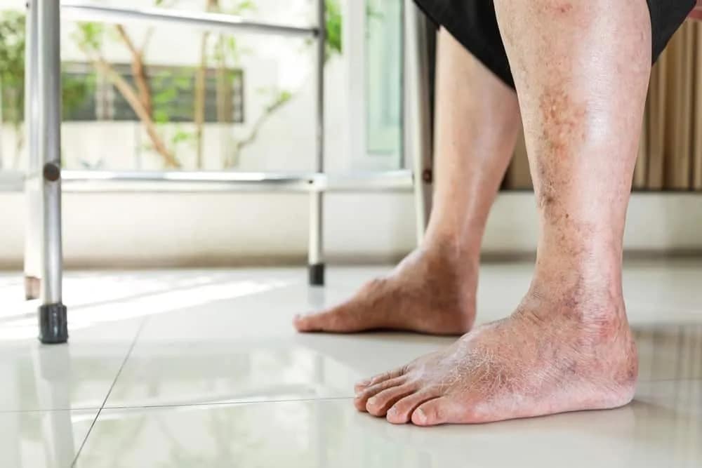 Cách giảm sưng tấy và nhức mỏi chân người lớn tuổi
