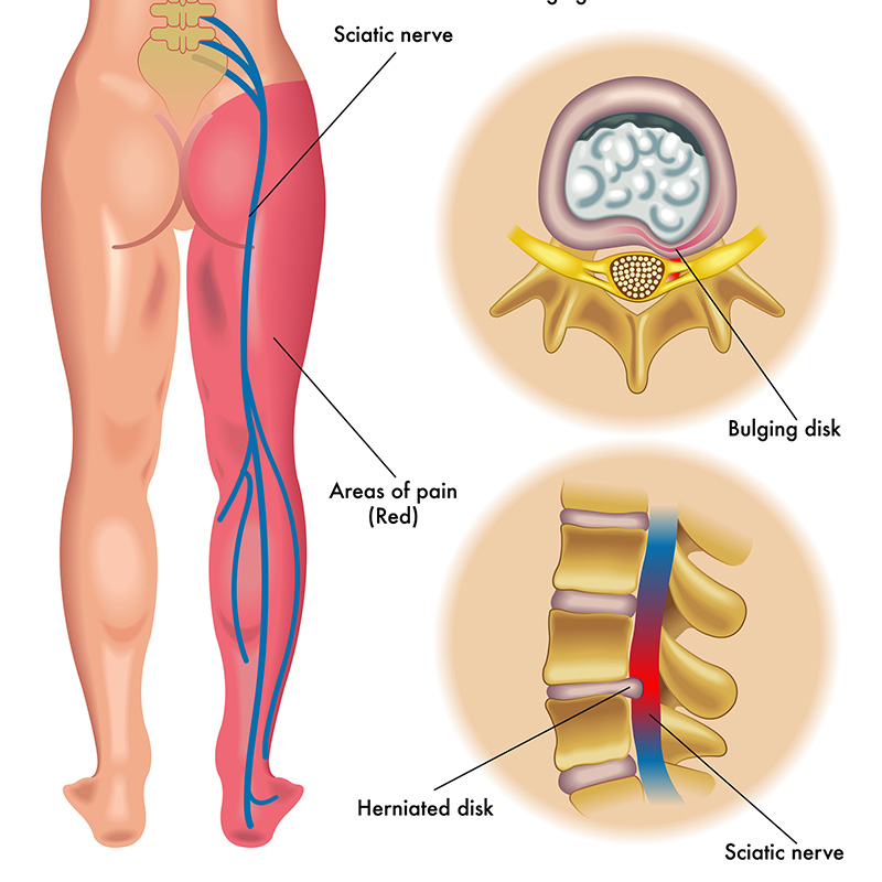 Hiểu đúng về thoát vị đĩa đệm và thái hóa cột sống